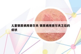 儿童银屑病用萌尔夫 银屑病用萌尔夫之后的症状