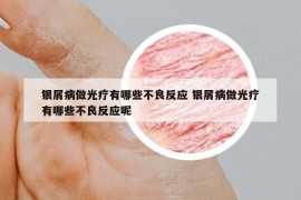 银屑病做光疗有哪些不良反应 银屑病做光疗有哪些不良反应呢