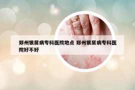 郑州银屑病专科医院地点 郑州银屑病专科医院好不好