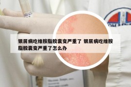 银屑病吃维胺脂胶囊变严重了 银屑病吃维胺脂胶囊变严重了怎么办