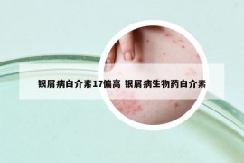 银屑病白介素17偏高 银屑病生物药白介素