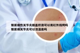 银屑病性关节炎膝盖积液可以用红外线烤吗 银屑病关节炎可以泡温泉吗