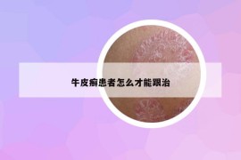 牛皮癣患者怎么才能跟治