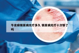 牛皮癣银屑病光疗多久 银屑病光疗十次够了吗