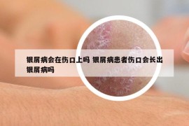 银屑病会在伤口上吗 银屑病患者伤口会长出银屑病吗