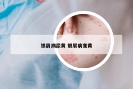 银屑病尿黄 银屑病变黄