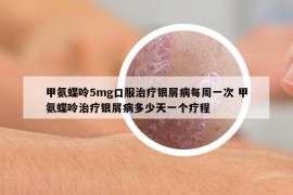 甲氨蝶呤5mg口服治疗银屑病每周一次 甲氨蝶呤治疗银屑病多少天一个疗程