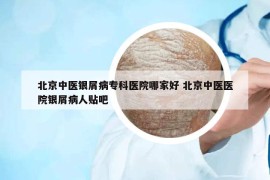 北京中医银屑病专科医院哪家好 北京中医医院银屑病人贴吧