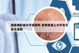 银屑病影响大学录取吗 有银屑病上大学会不会不录取