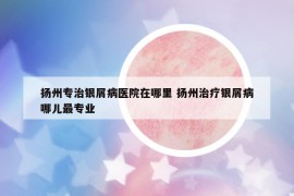 扬州专治银屑病医院在哪里 扬州治疗银屑病哪儿最专业