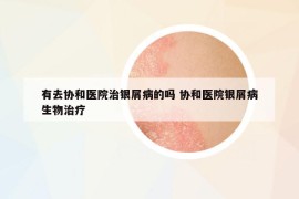 有去协和医院治银屑病的吗 协和医院银屑病生物治疗