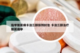 指甲银屑病卡泊三醇搽剂封包 卡泊三醇治疗银屑病甲