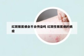 红斑银屑病会不会传染吗 红斑性银屑病的病症