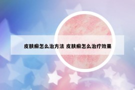 皮肤癣怎么治方法 皮肤癣怎么治疗效果