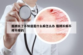 胳膊长了不知道是什么癣怎么办 胳膊长癣不疼不痒的