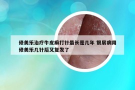 修美乐治疗牛皮癣打针最长是几年 银屑病用修美乐几针后又复发了