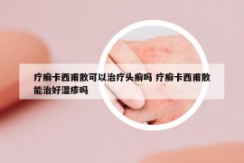 疗癣卡西甫散可以治疗头癣吗 疗癣卡西甫散能治好湿疹吗