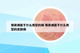 银屑病属于什么类型的病 银屑病属于什么类型的皮肤病