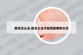 藓该怎么治 藓怎么治才能彻底根除方法