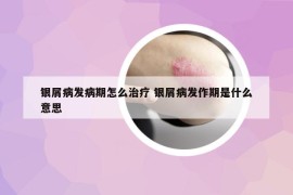 银屑病发病期怎么治疗 银屑病发作期是什么意思