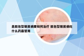 患脓包型银屑病要如何治疗 脓包型银屑病吃什么药最管用