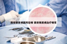 西安银屑病医院在哪 西安银屑病治疗哪家