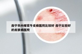 南宁市内哪家牛皮癣医院比较好 南宁比较好的皮肤病医院