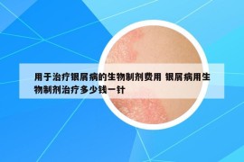 用于治疗银屑病的生物制剂费用 银屑病用生物制剂治疗多少钱一针