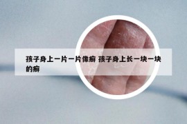 孩子身上一片一片像癣 孩子身上长一块一块的癣