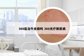 308能治牛皮癣吗 308光疗银屑病