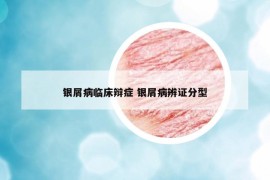 银屑病临床辩症 银屑病辨证分型