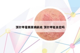 顶针甲是银屑病前兆 顶针甲能自愈吗