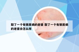 取了一个有银屑病的老婆 取了一个有银屑病的老婆会怎么样