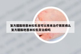 复方醋酸地塞米松乳膏可以用来治疗银屑病么 复方醋酸地塞米松乳膏治癣吗