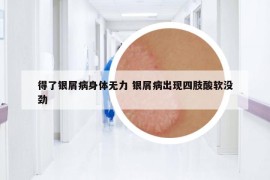 得了银屑病身体无力 银屑病出现四肢酸软没劲