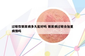 过敏性银屑病多久能好吗 银屑病过敏会加重病情吗