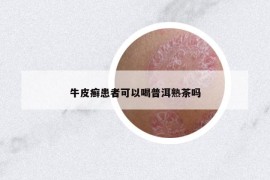 牛皮癣患者可以喝普洱熟茶吗