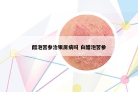 醋泡苦参治银屑病吗 白醋泡苦参