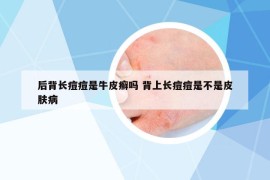 后背长痘痘是牛皮癣吗 背上长痘痘是不是皮肤病