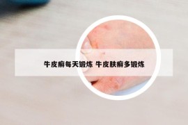 牛皮癣每天锻炼 牛皮肤癣多锻炼