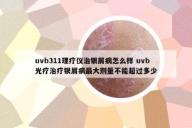 uvb311理疗仪治银屑病怎么样 uvb光疗治疗银屑病最大剂量不能超过多少