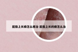 屁股上长癣怎么根治 屁股上长的癣怎么治