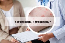 儿童银屑病疼吗 儿童银屑病痒吗?