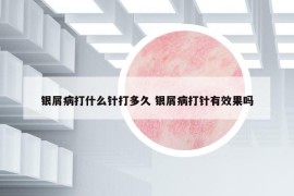 银屑病打什么针打多久 银屑病打针有效果吗