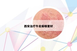 西安治疗牛皮癣哪里好