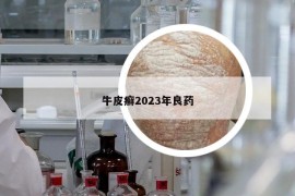 牛皮癣2023年良药