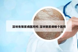 深圳有银屑病医院吗 深圳银屑病哪个医院