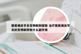 银屑病关节炎生物制剂报销 治疗银屑病关节炎的生物制剂有什么副作用