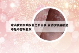 水滴状银屑病反复怎么回事 点滴状银屑病是不是不容易复发