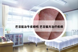 巴豆能冶牛皮癣吗 巴豆偏方治疗疾病